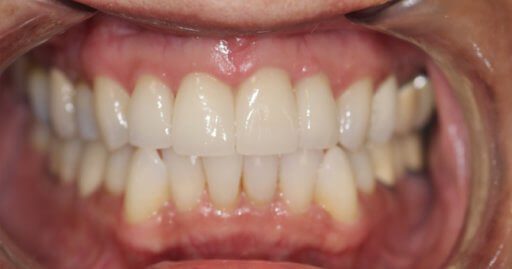 after periodontal work