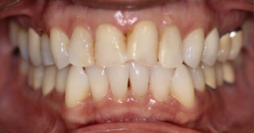 before periodontal work
